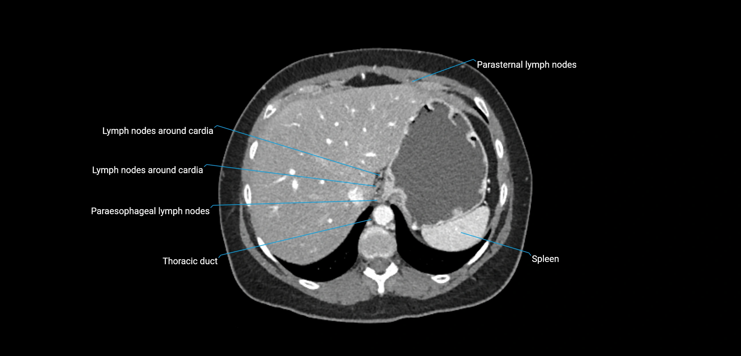 CT ct abdominal lymph nodes  axial cross sectional anatomy  enchanced radiology image -img-00002-00097.webp